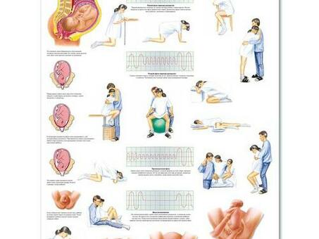 Медицинский плакат "Роды"