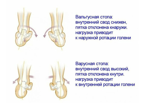 Массаж при плосковальгусной стопе у детей