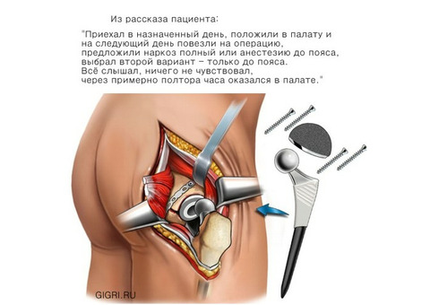 Тазобедренный сустав Германия операции в Германии