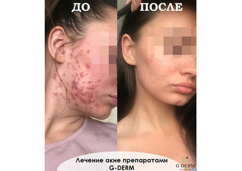 Чистка лица очищающая омолаживающая