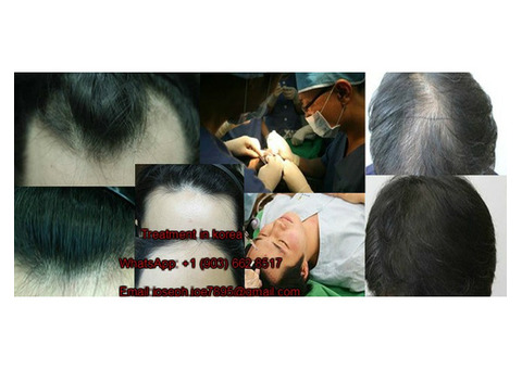 ХТрансплантацию волос методом Implanter Pen FUE.